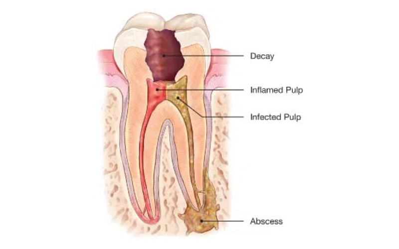 Root Canals - Spring Valley Dental Care, Maywood, NJ