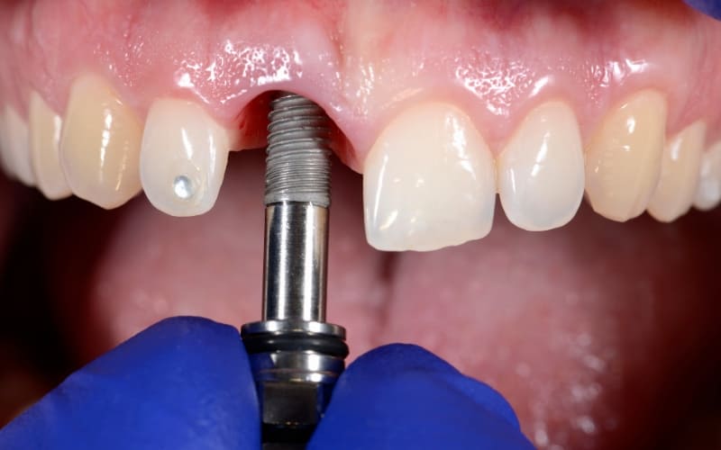 Dental Implants - Spring Valley Dental Care, Maywood, NJ