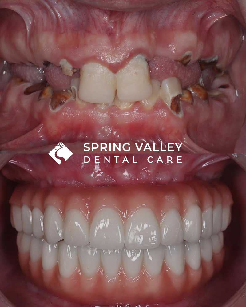 Before After all on x