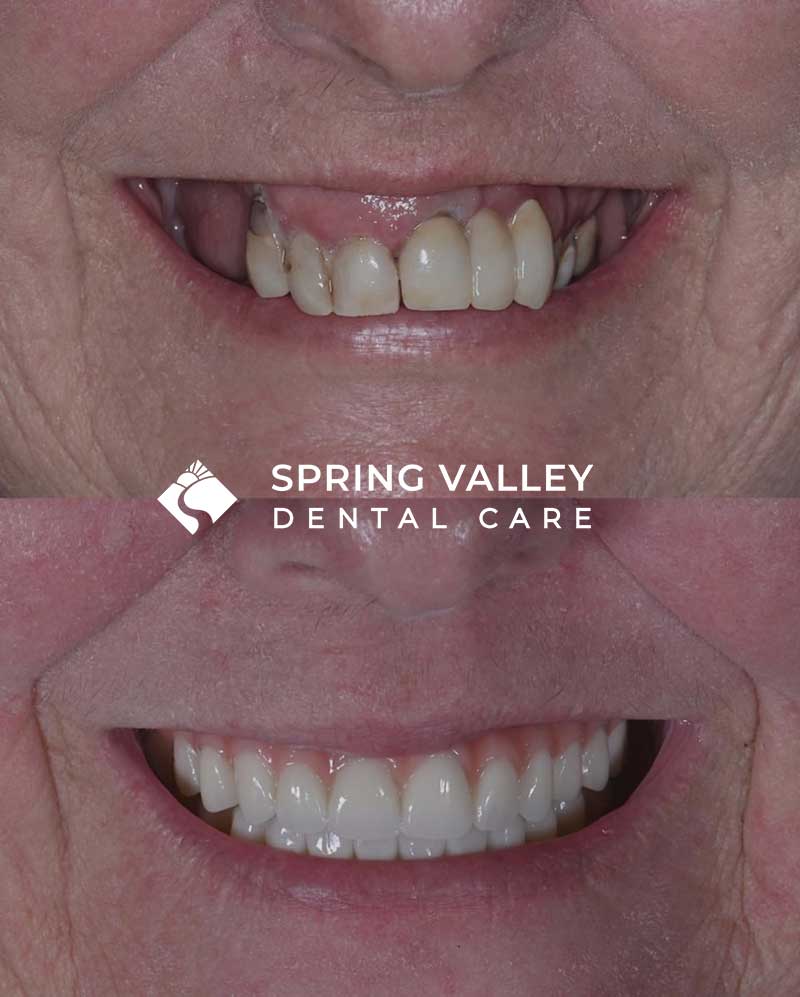 Before After all on x