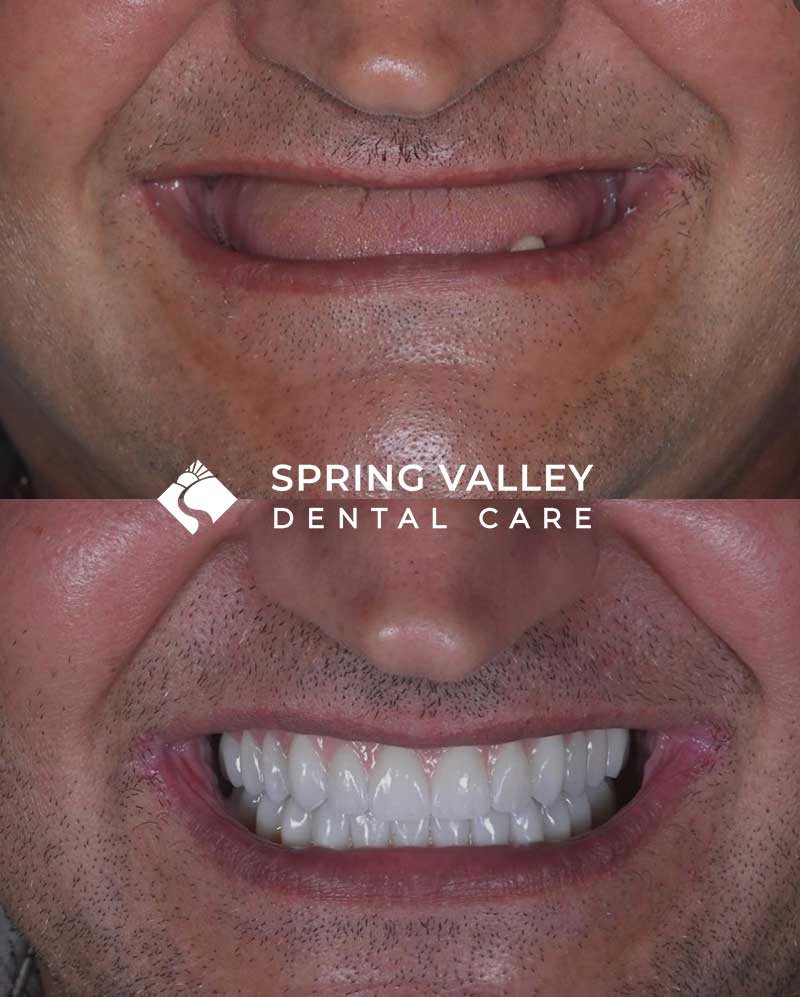 Before After all on x