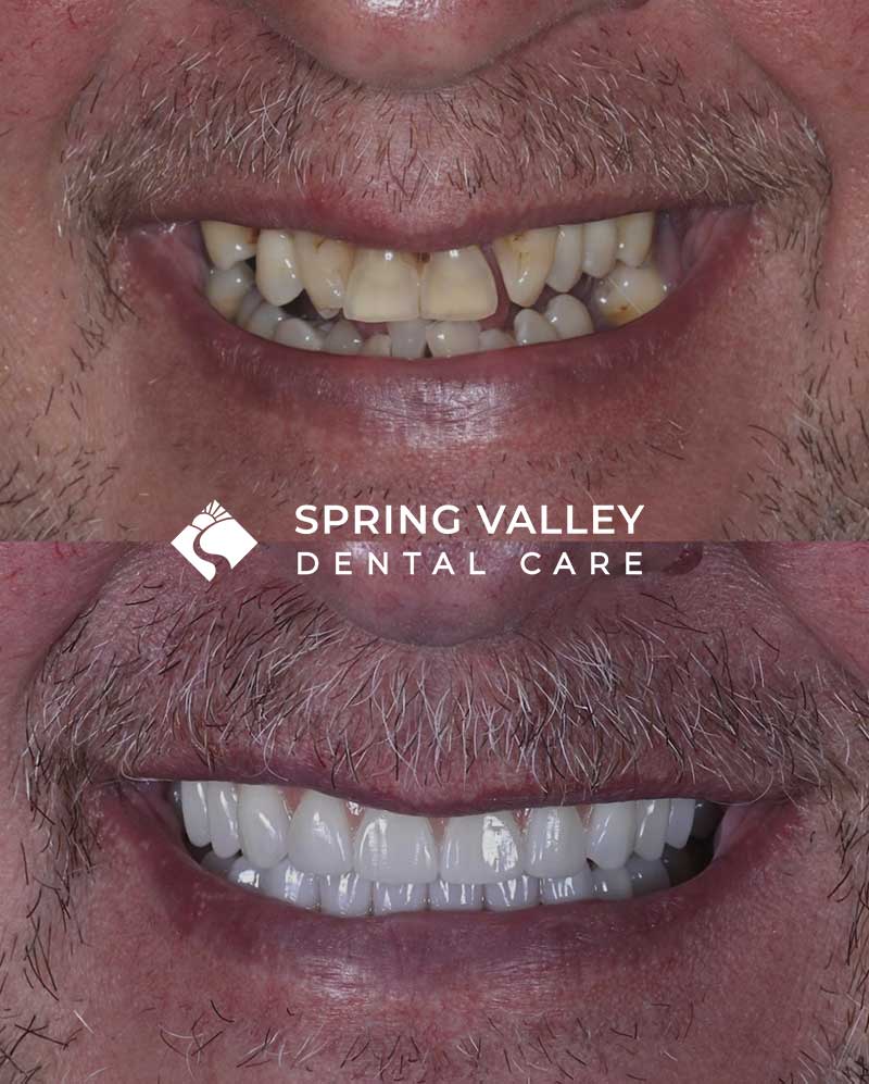 Before After all on x