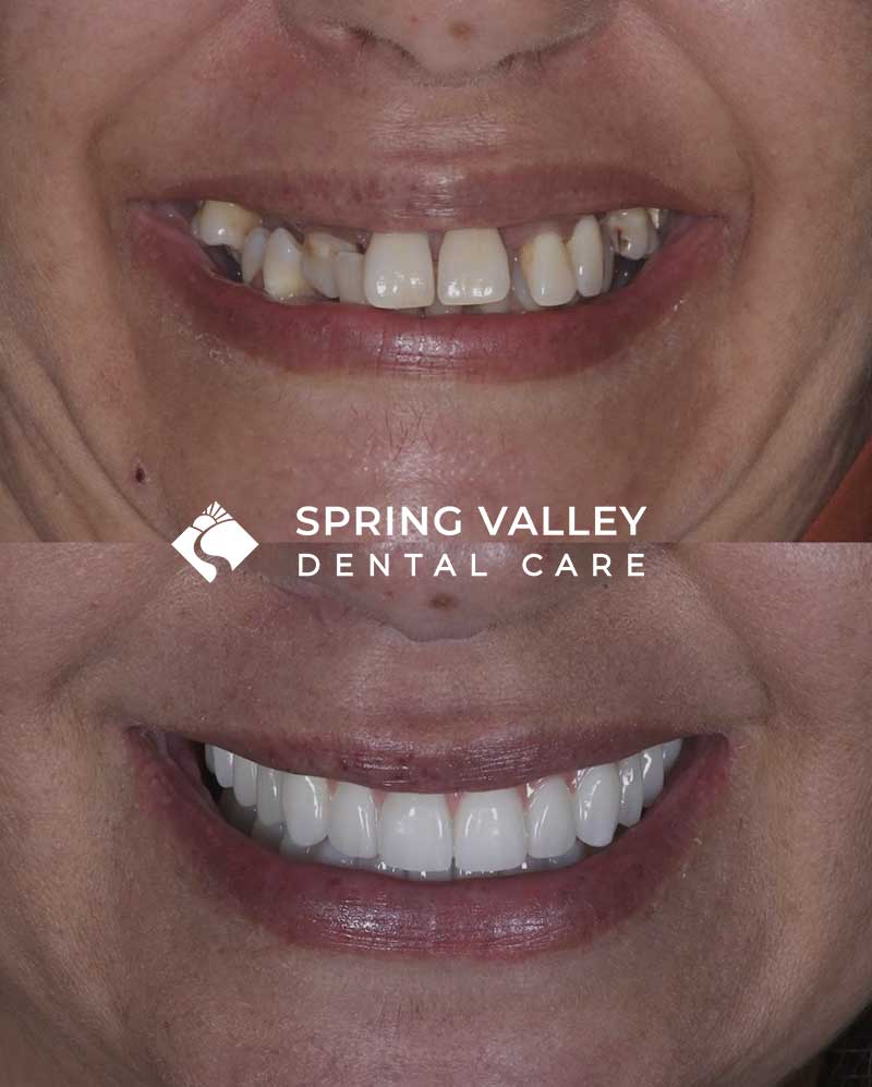 Before After all on x