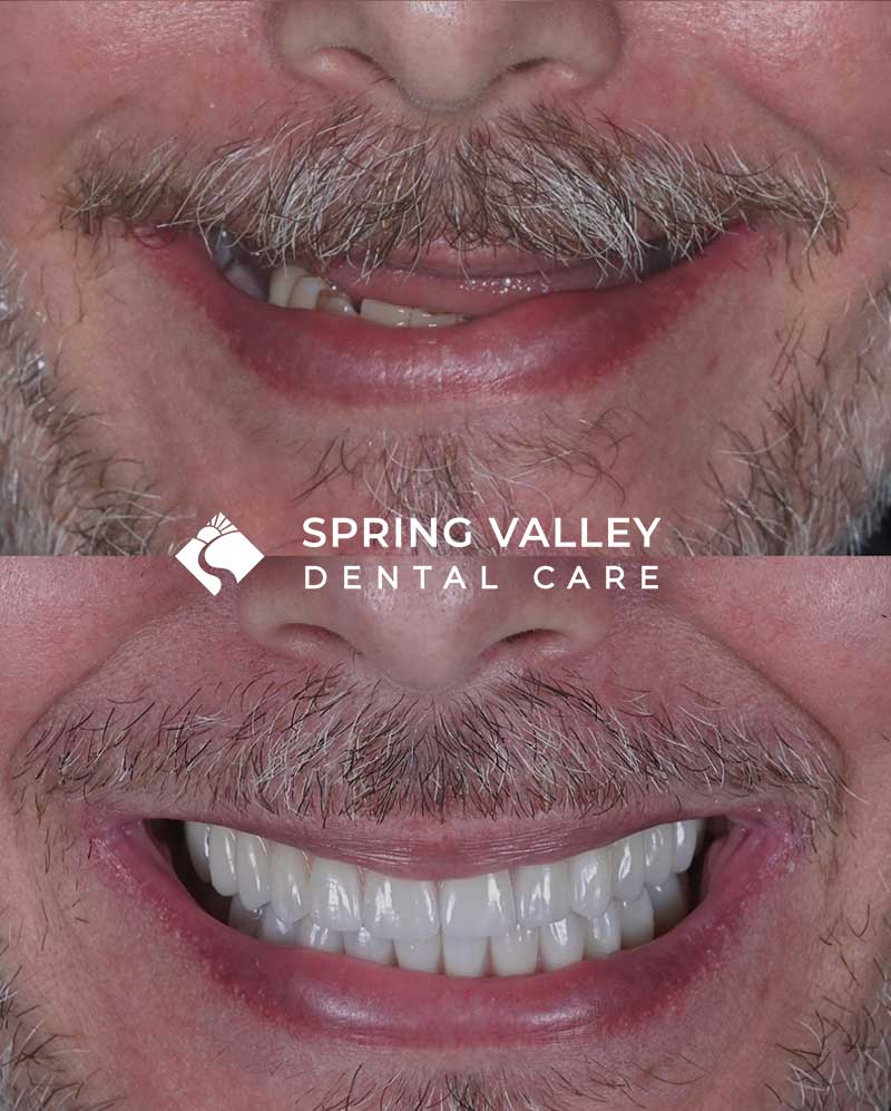 Before After all on x