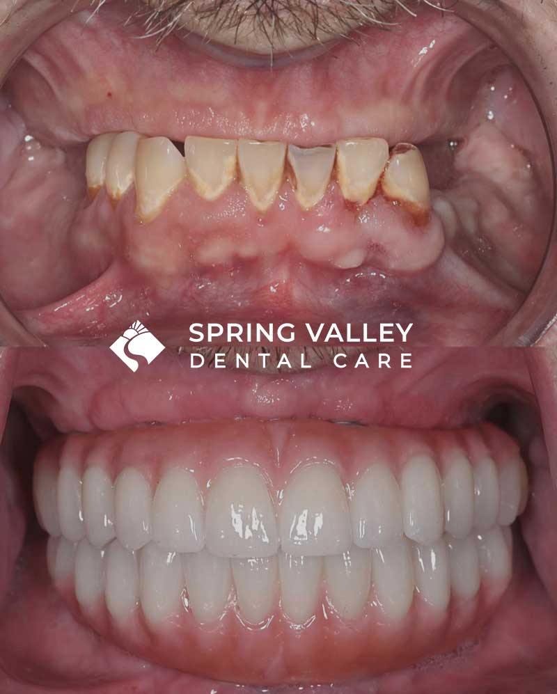 Before After all on x