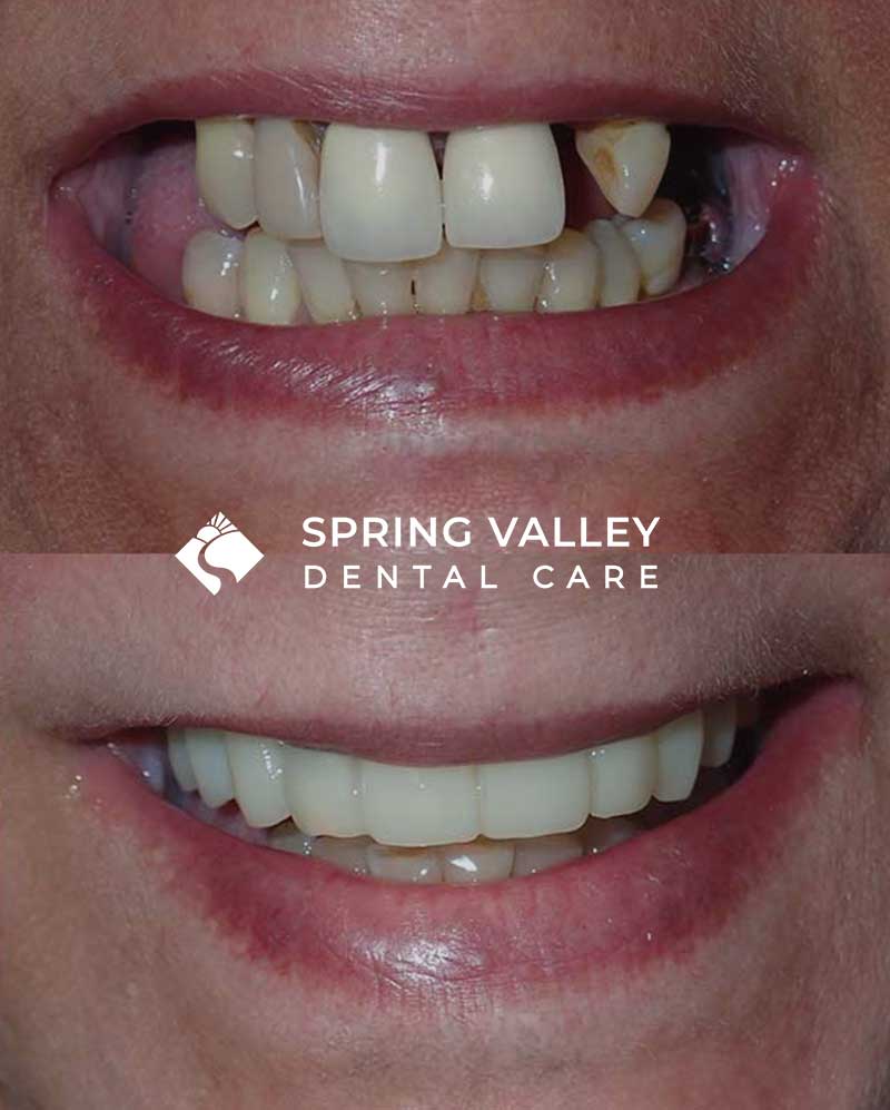 Before After Spring Valley