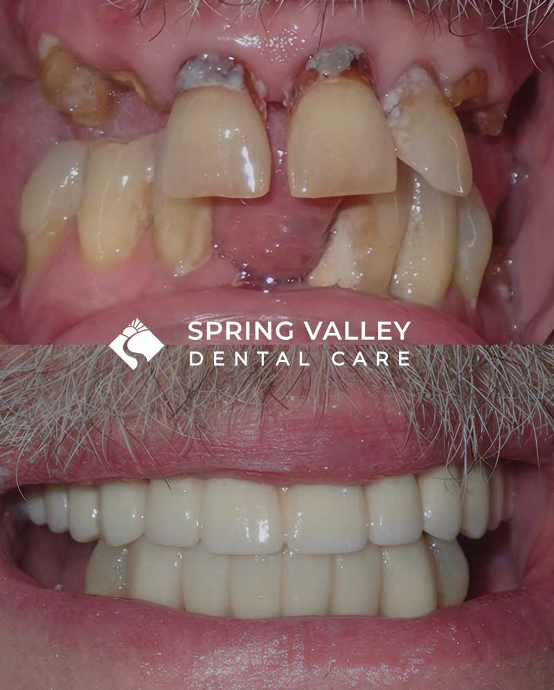 Before After Spring Valley