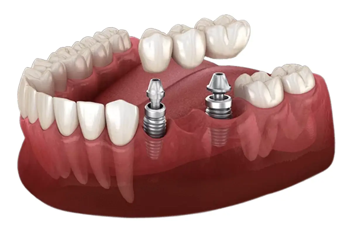 Implant-supported dental bridge replacing multiple missing teeth