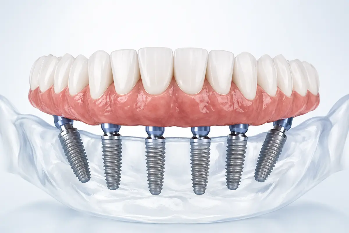All-on-4 All-on-X dental implant bridge replacing full arch of teeth