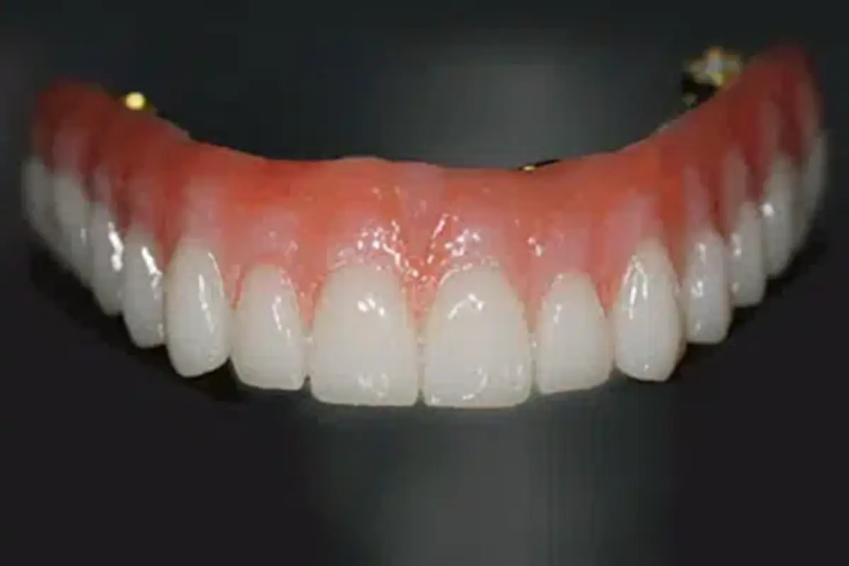 Snap-on overdenture implant-retained dentures
