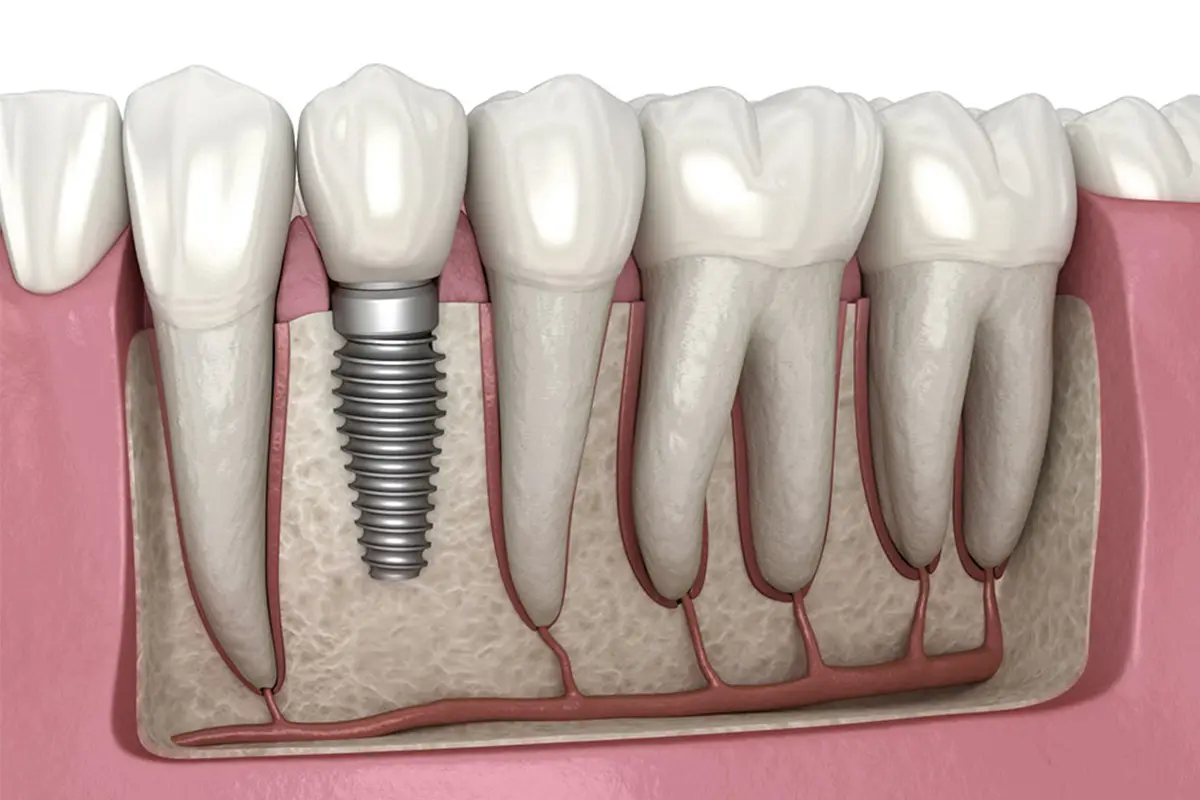Dental implant diagram showing titanium post and crown