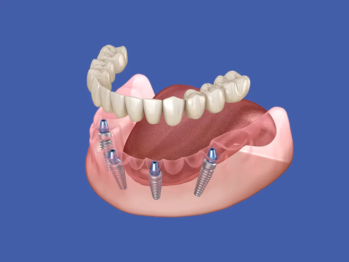 All-on-Four diagram showing a fixed full-arch bridge anchored to four titanium implants