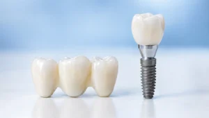A three-unit dental bridge next to a single dental implant with crown, side by side