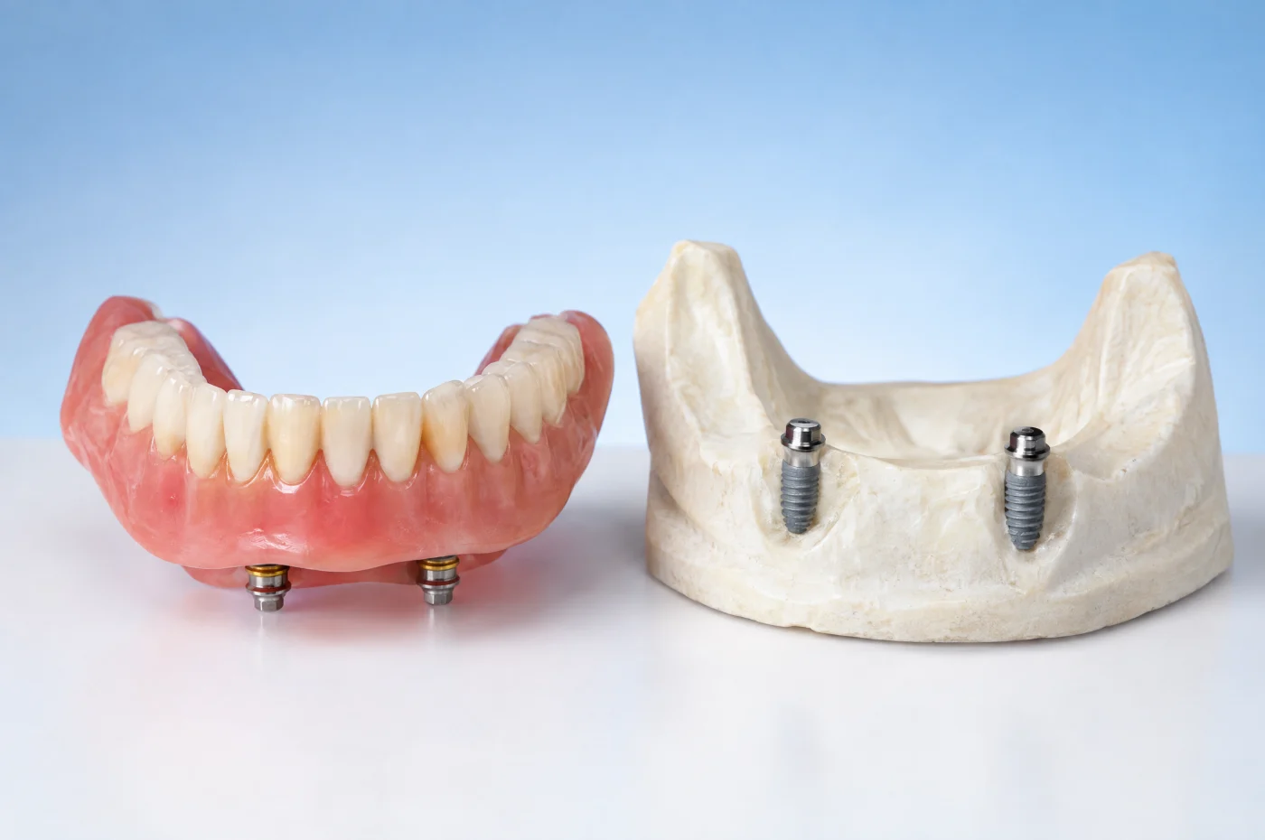 Implant-retained snap-in overdenture next to a jaw model with two dental implants