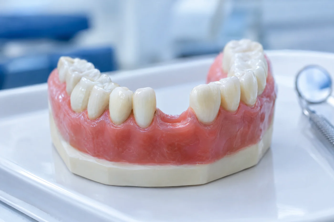 Dental model of a lower jaw used to plan tooth replacement